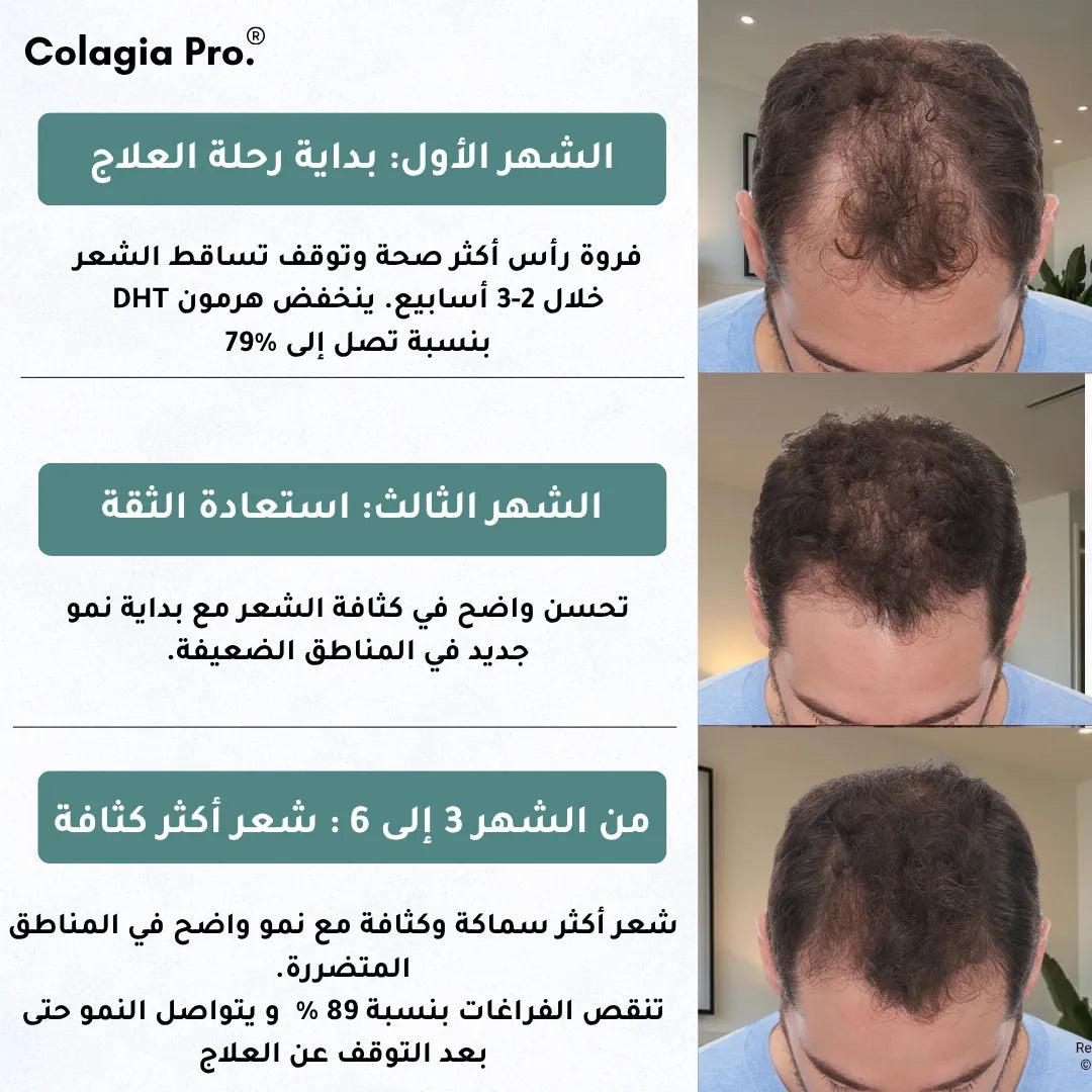 Colagia Pro® | علاج  طبي متطور لتساقط الشعر و استعادة النمو