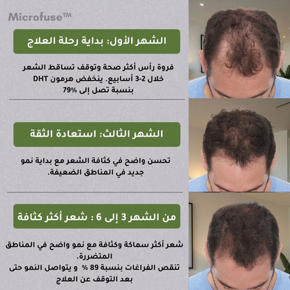 Microfuse | علاج طبي متطور لتساقط الشعر و اعادة النمو